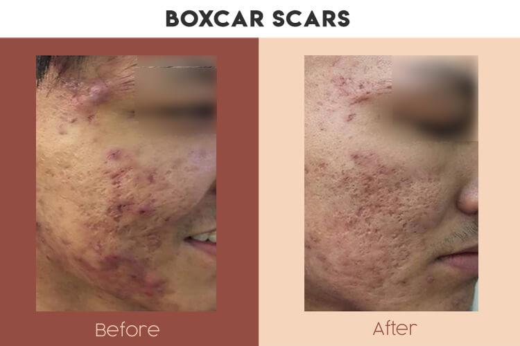 Actual Photo of Boxcar Scars Result