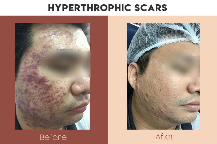 Actual Photo of Hypertrophic Scars Result