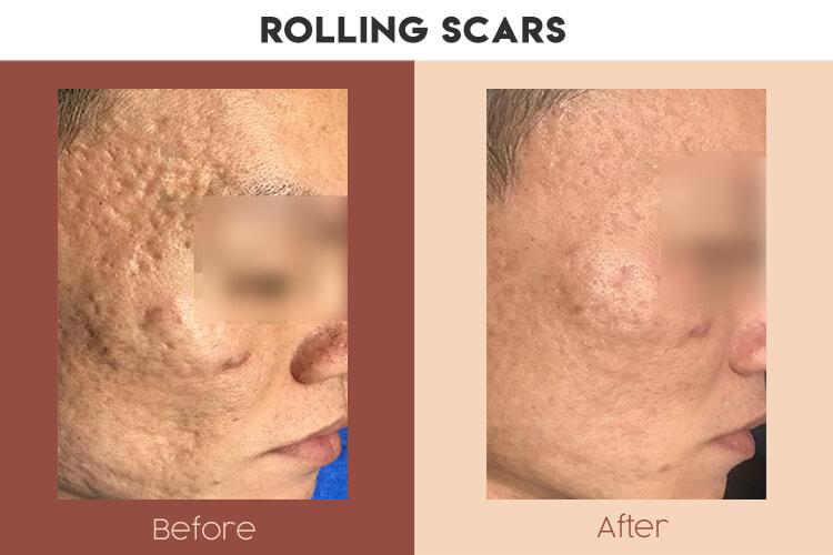 Actual Photo of Rolling Scars Result