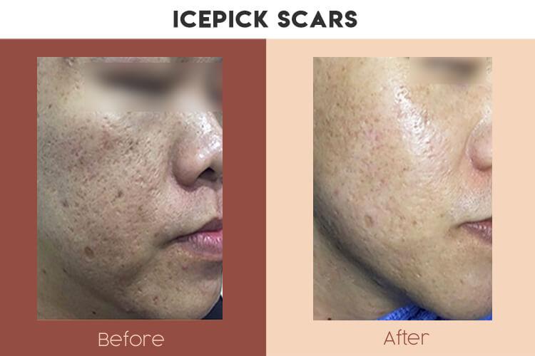Actual Photo of Icepick Scars Result