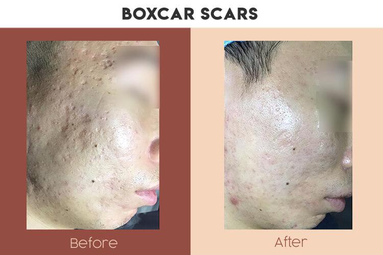 Actual Photo of Boxcar Scars Result