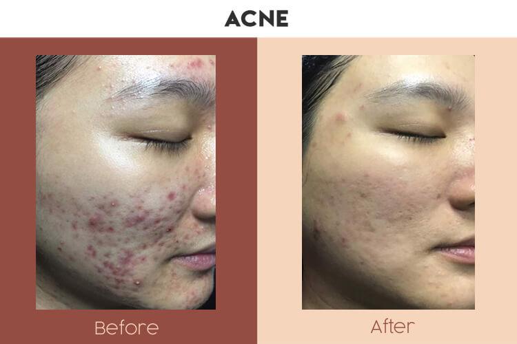 Actual Photo of Acne Result