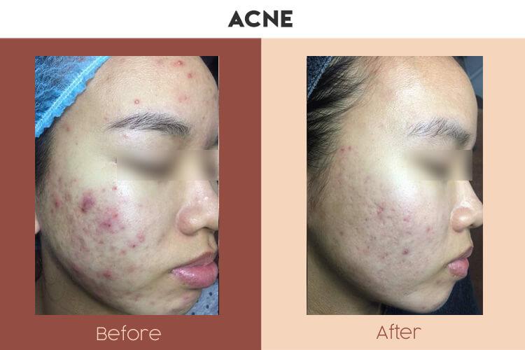 Actual Photo of Acne Result