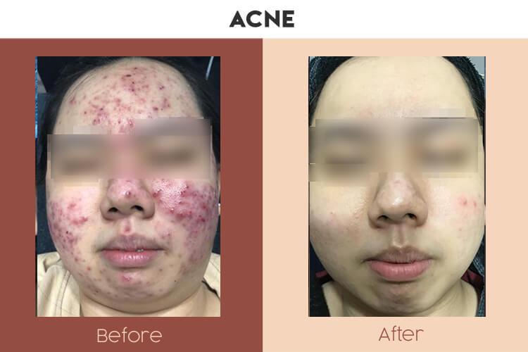Actual Photo of Acne Result