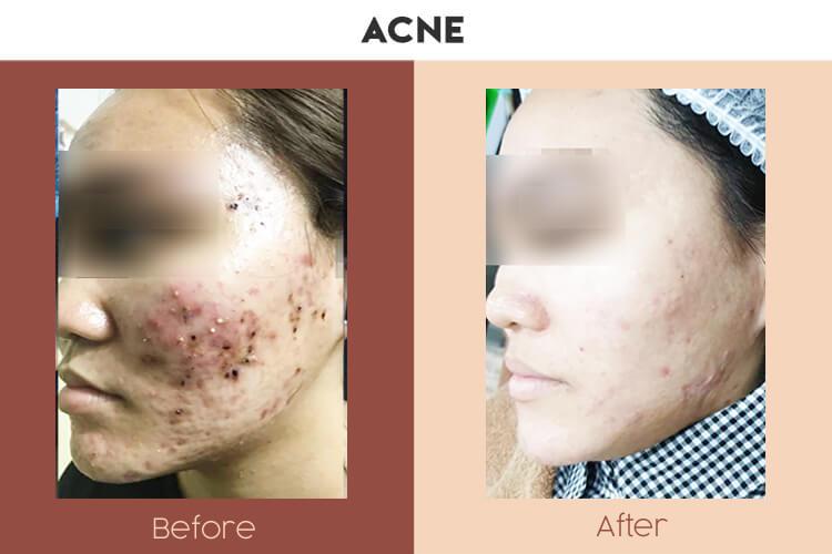Actual Photo of Acne Result
