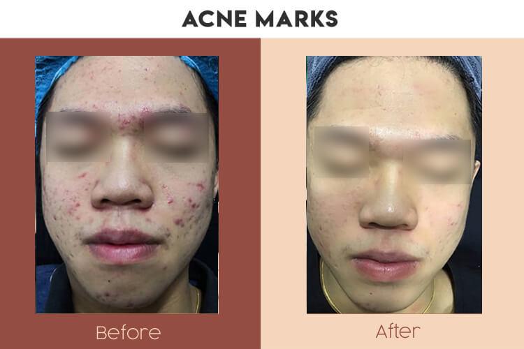 Actual Photo of Acne Marks Result