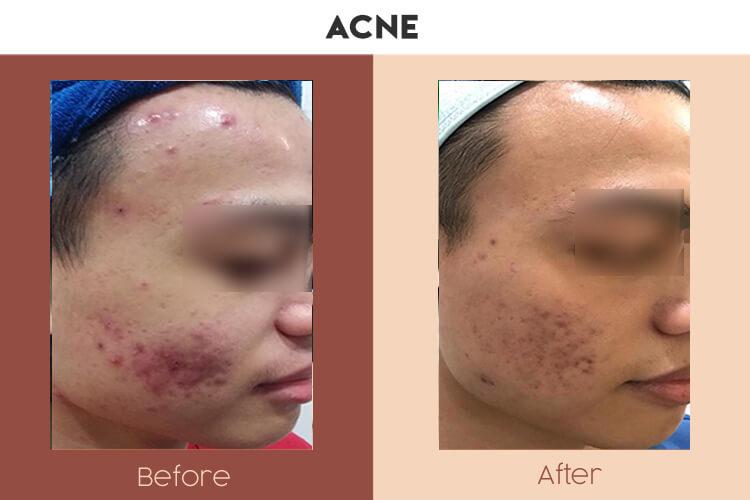 Actual Photo of Acne Result