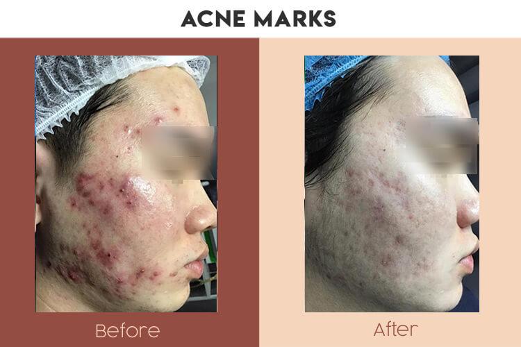 Actual Photo of Acne Marks Result