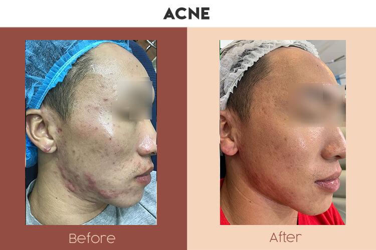 Actual Photo of Acne Result