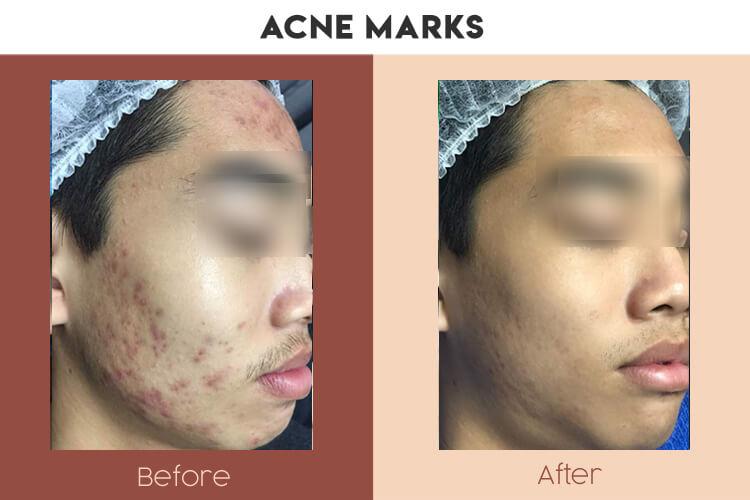 Actual Photo of Acne Marks Result