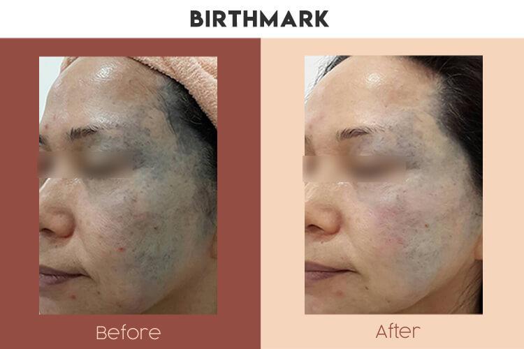 Actual Photo of Pigmentation - Birthmark Result