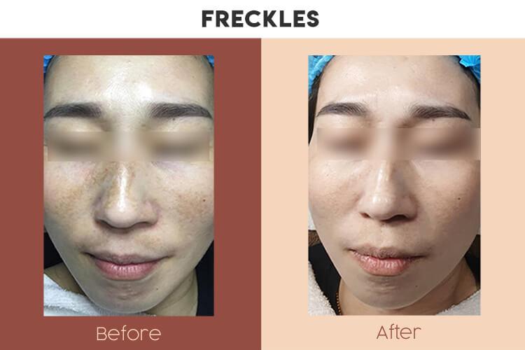 Actual Photo of Pigmentation - Freckles Result