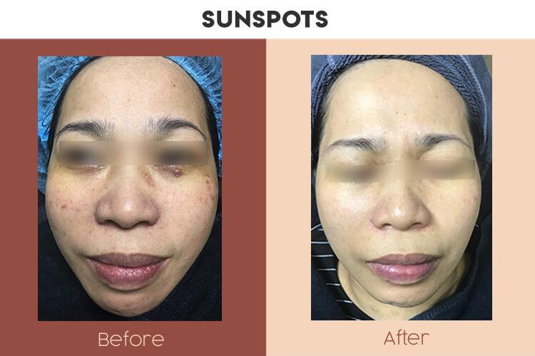 Actual Photo of Pigmentation - Sunspots Result