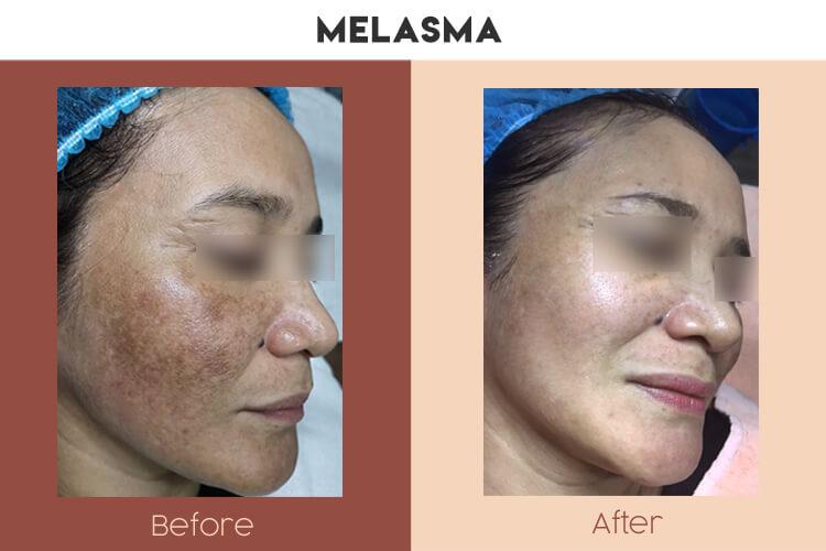 Actual Photo of Pigmentation - Melasma Result