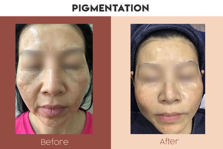 Actual Photo of Pigmentation Result