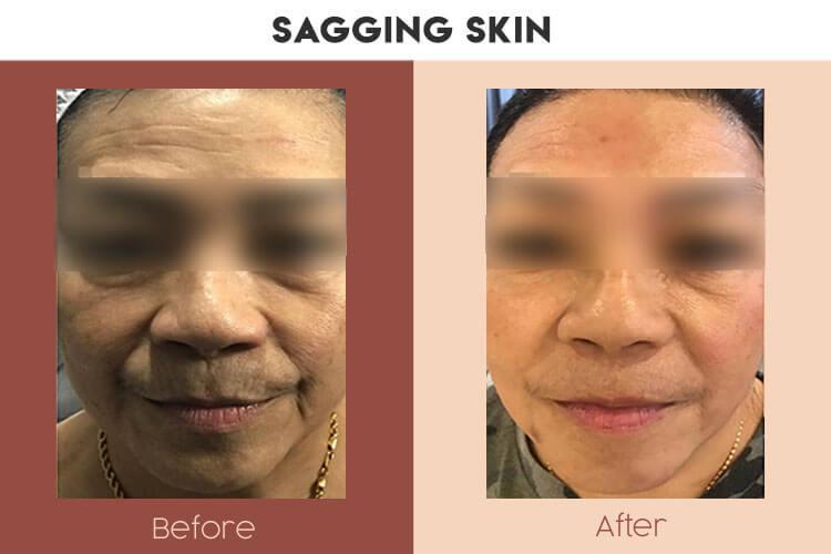 Actual Photo of Sagging Skin Result